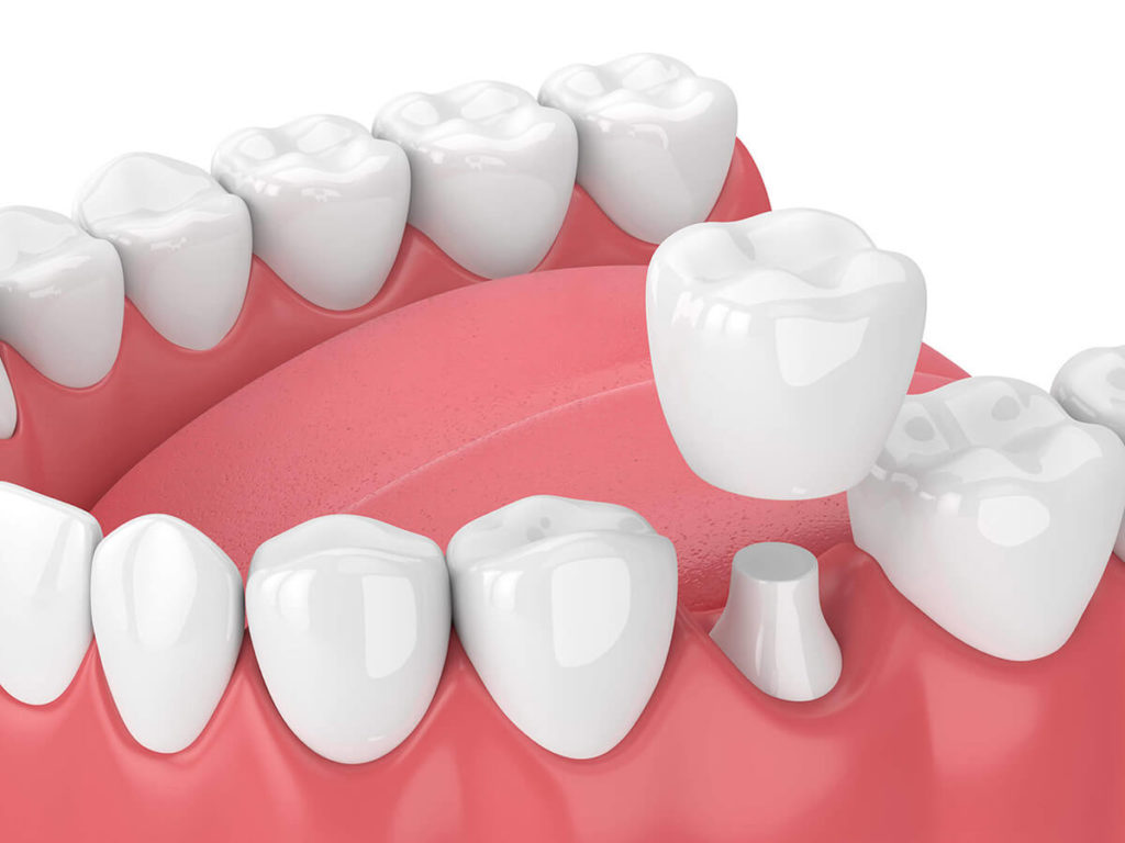 illustration of a dental crown being applied to a tooth