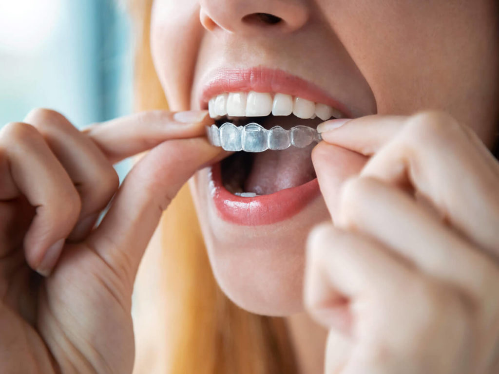 A person inserting clear dental aligners onto their teeth, focusing on the hands and mouth.