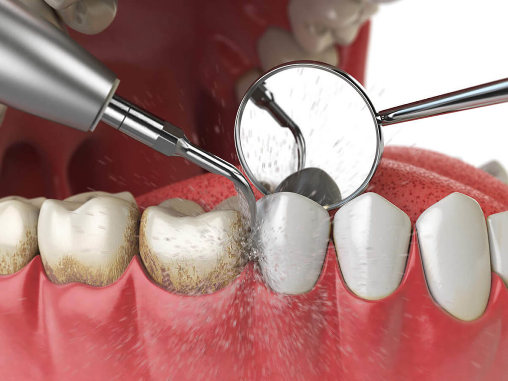 Illustration of a dental cleaning procedure with an ultrasonic scaler removing tartar from teeth.