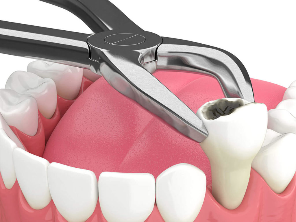 illustration of a tooth extraction