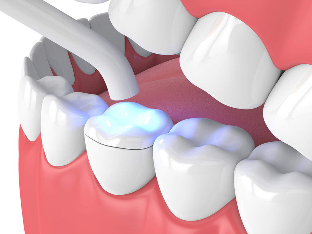 Illustration of a dental procedure with a curing light being used to harden a tooth-colored filling on a molar.