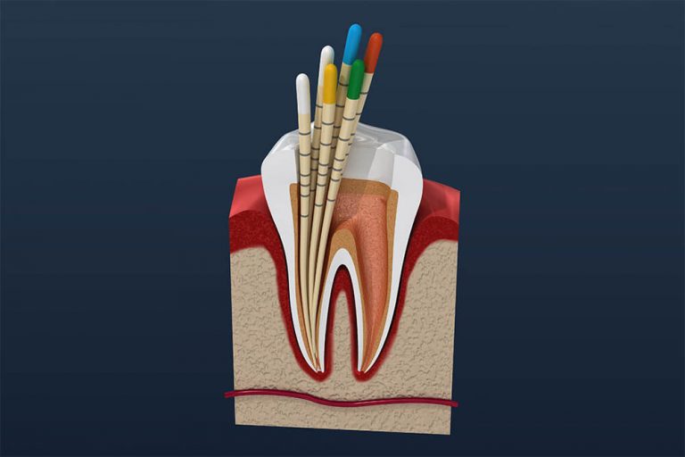 Illustration of a cross-section of a tooth undergoing root canal therapy, showing endodontic files cleaning the root canals.
