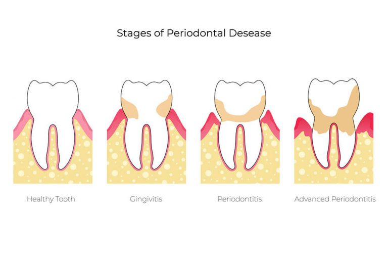 Illustration showing the stages of periodontal disease: a healthy tooth, gingivitis, periodontitis, and advanced periodontitis, highlighting the progression of gum and bone damage.