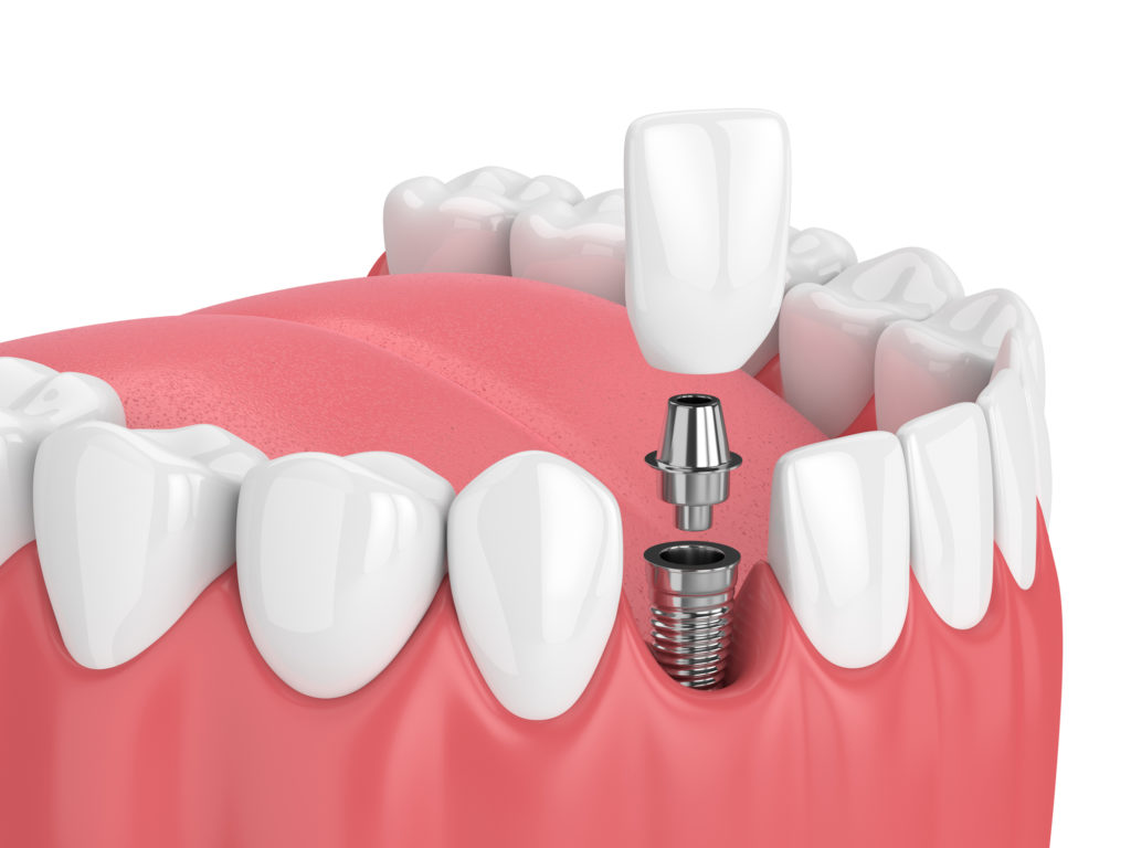 Illustration of a bottom row of teeth with a dental implant being applied