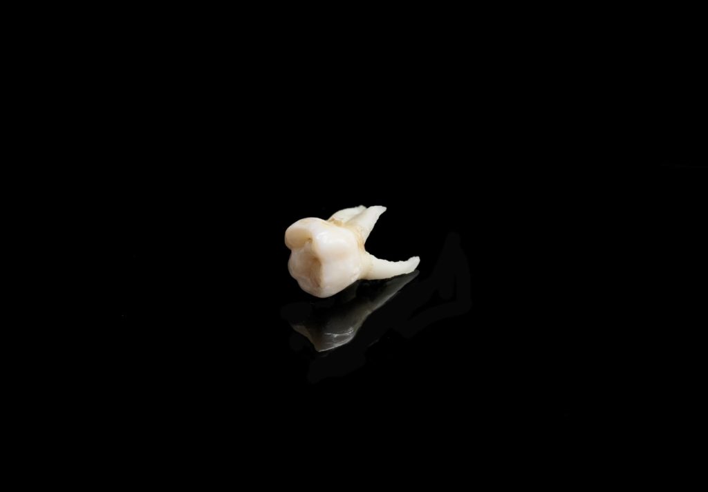 drum hill dental, tooth extraction, tooth removal