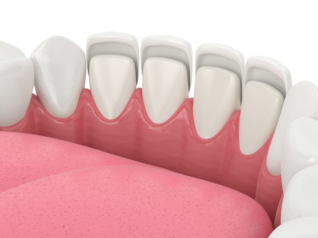 Illustration of a bottom row of teeth with a set of veneers being applied