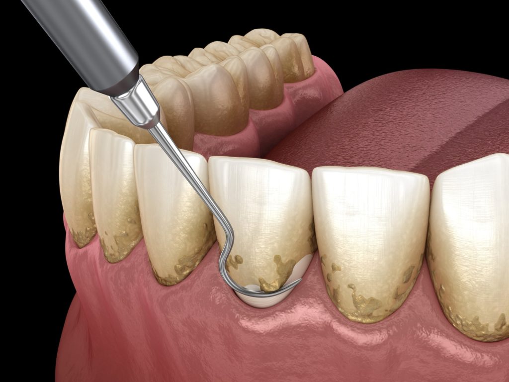 Gum Disease Peridontal Disease Treatment Drum Hill Dental