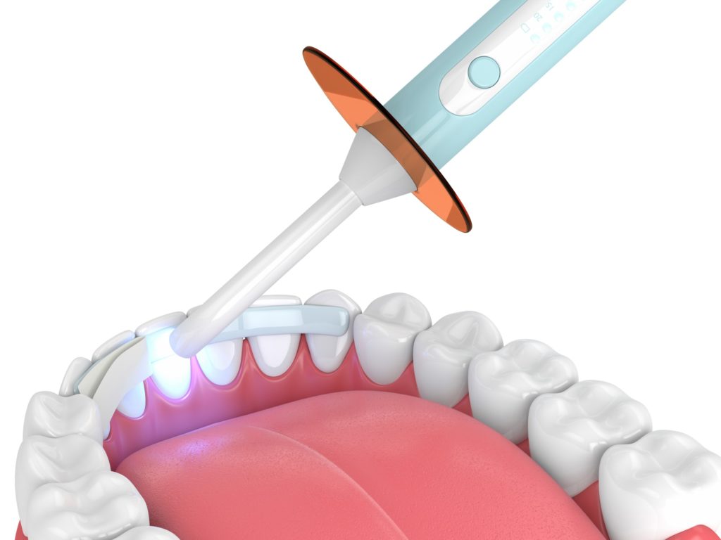 Illustration of a dental bond being applied to the backside of a bottom row of teeth