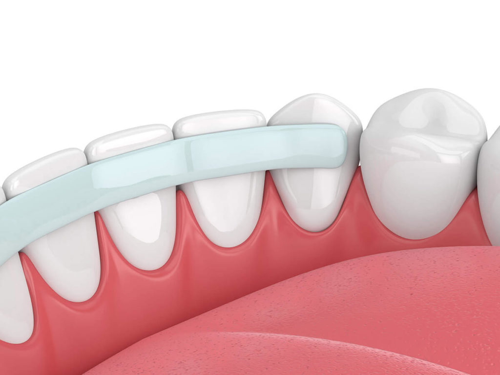 Illustration of a dental splint applied to the inside of the upper teeth, showing the splint supporting the teeth and gums.