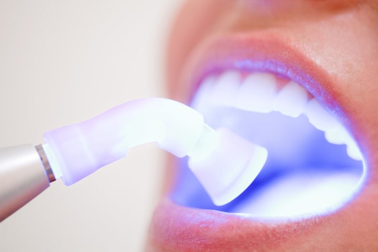 A laser dentistry tool with its light being shown in an open mouth