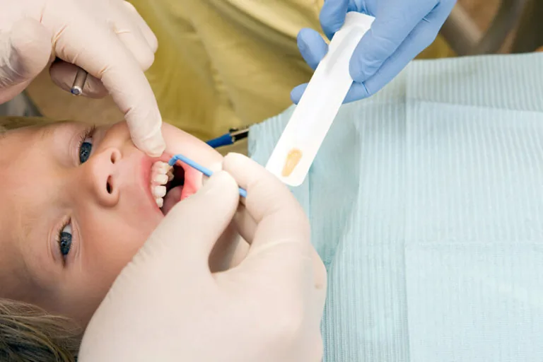 A child receiving dental treatment, with a dental professional applying sealant to the child's teeth using a small brush.