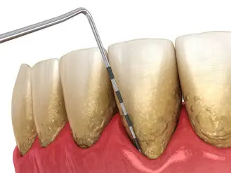 Close‑up illustration of teeth with yellowish tartar deposits along gum line, red inflamed gums, and dental probe measuring periodontal pockets.