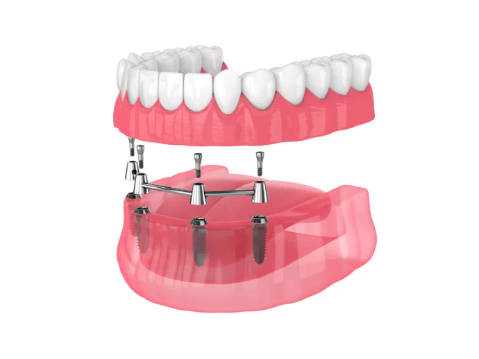 All-on-4 Dental Implants in Chelmsford, MA at Drum Hill Family Dentists