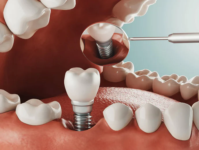 Dental implants in Chelmsford, MA at Drum Hill Family Dentists